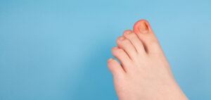 陥入爪で少し炎症している画像